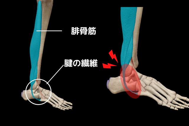 ランニング 靴 足首 痛み 人気